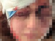 Пьяный муж сломал поленом нос жене