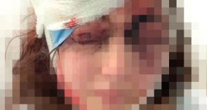 Пьяный муж сломал поленом нос жене