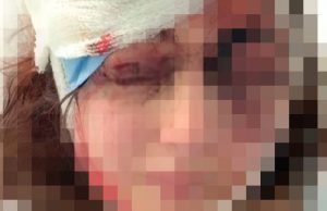 Пьяный муж сломал поленом нос жене