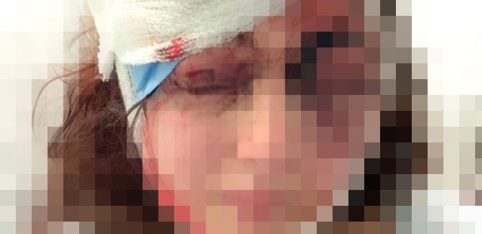 Пьяный муж сломал поленом нос жене
