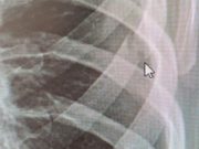 Пьяный парень сломал пожилому соседу ребра Пьяный парень сломал пожилому соседу ребра