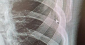 Пьяный парень сломал пожилому соседу ребра Пьяный парень сломал пожилому соседу ребра