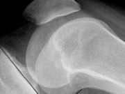 Житель Онгудая, отбиваясь от полицейского, повредил ему колено