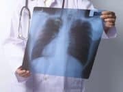 За год туберкулез выявили у 75 жителей региона За год туберкулез выявили у 75 жителей региона