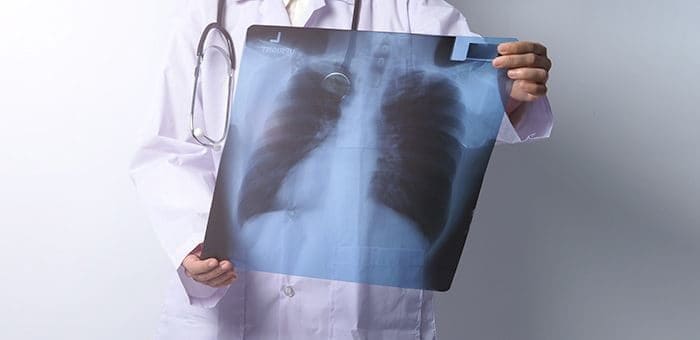За полгода на Алтае туберкулезом заболели 34 человека