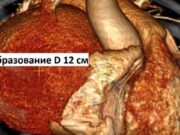 Жительницу Республики Алтай с редкой аномалией сердца спасли в клинике Мешалкина photo 2026 10 07 13 24 59