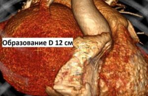 Жительницу Республики Алтай с редкой аномалией сердца спасли в клинике Мешалкина photo 2026 10 07 13 24 59